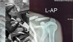 Hamka Pembalap Seruyan Alami Patah Bahu Akibat Tumpahan Oli, Panitia Kejurnas Motoprix Kalteng 2026 Tanggung Seluruh Biaya Medis