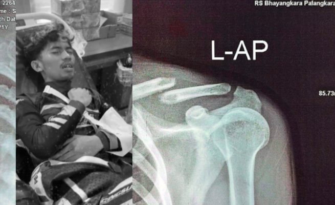 Hamka Pembalap Seruyan Alami Patah Bahu Akibat Tumpahan Oli, Panitia Kejurnas Motoprix Kalteng 2026 Tanggung Seluruh Biaya Medis
